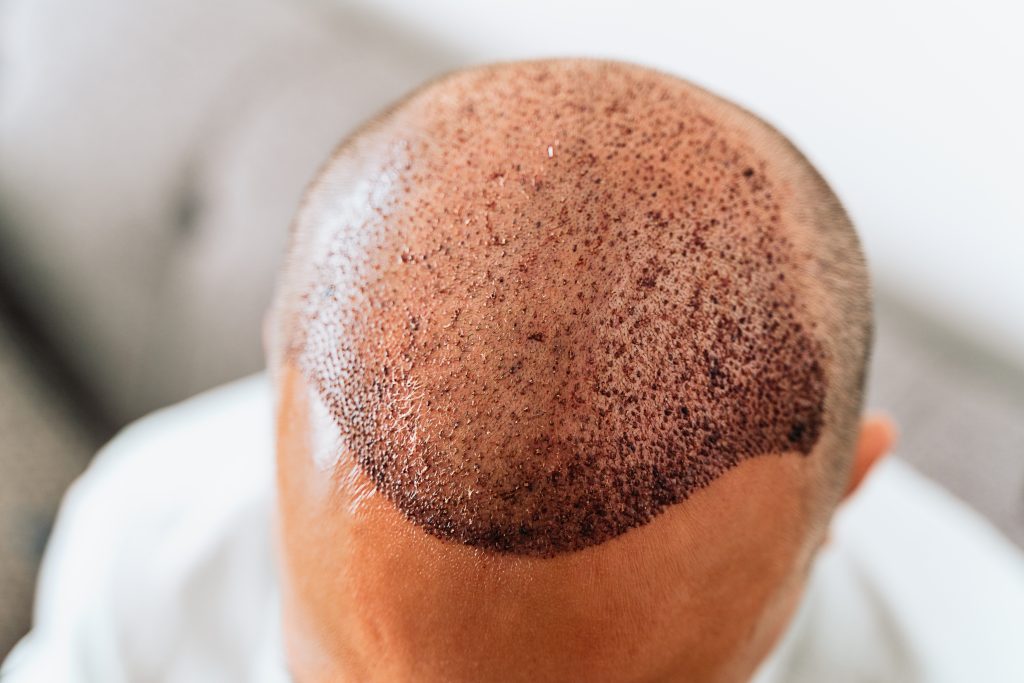 hair transplant