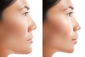 rhinoplasty in korea rhinoplasty