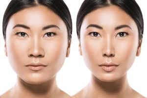 V line surgery jaw reduction jaw contouring