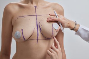 Autologous Breast Augmentation